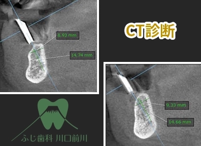 入れ歯（義歯）の症例1の術前の写真