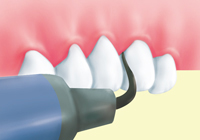 1.歯石の除去