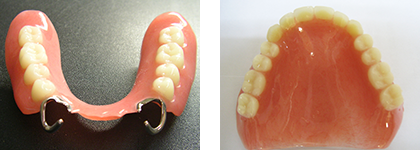 レジン（プラスチック）床義歯のイメージ写真