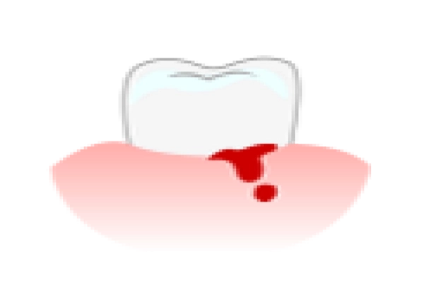 歯肉から血が出るのイメージ写真