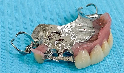 金属床義歯のイメージ写真